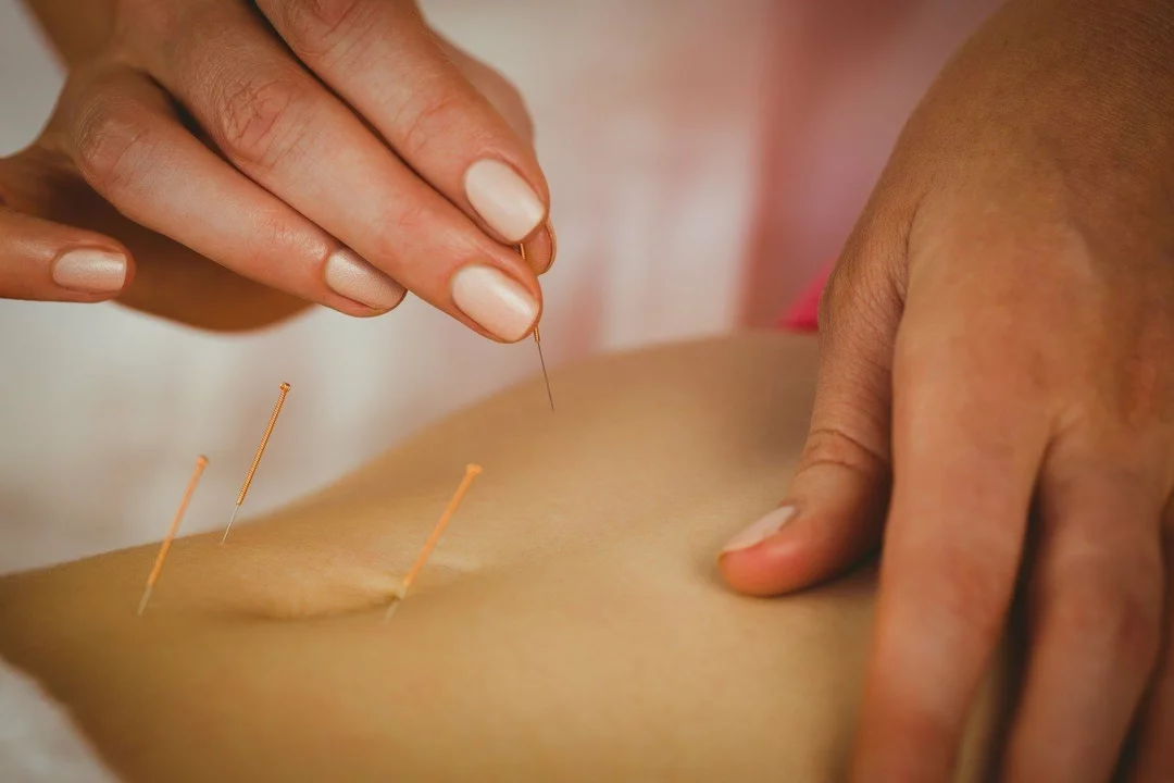 The Role of Acupuncture in Infertility Treatment
